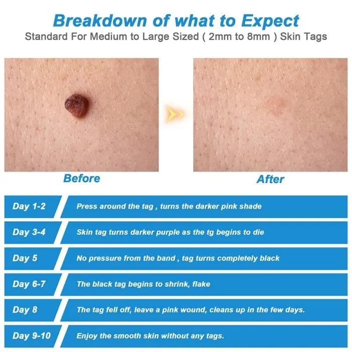 Painless Skin Tag Rempover