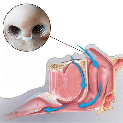 Tongue Stabilizer Mouthpiece for Snoring Reduction