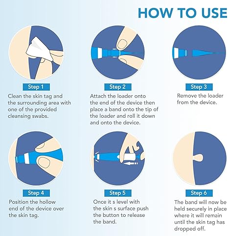 Skin Tag Removal Tool