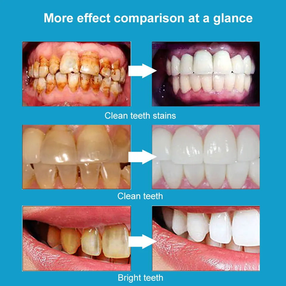 Teeth Whitening Gel Pen Magic Natural Formula for a Brighter Smile