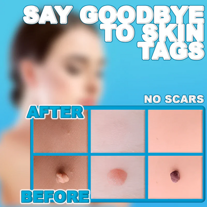 Skin Tag Remover Painless and Easy Home Treatment