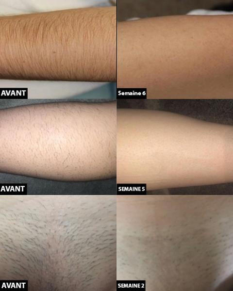 Permanent laser hair removal